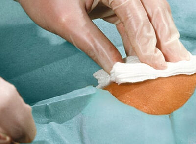 Χειρουργικό Πεδίο 2ply Αυτοκόλλητο με Οπή Foliodrape